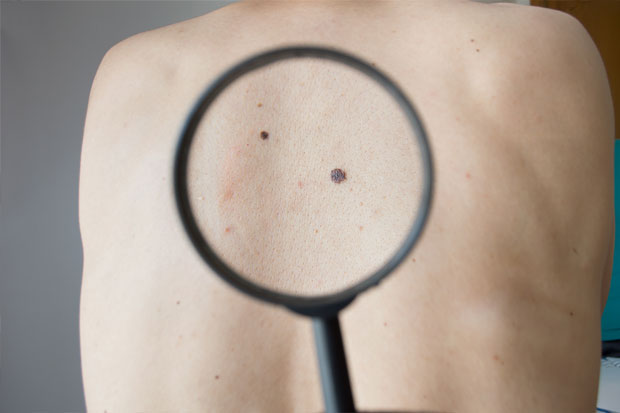 Melanoma: olhe para a sua pele com atenção