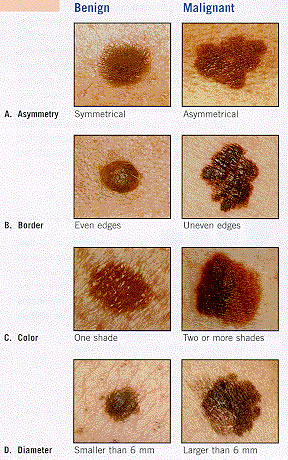 Identificar Melanoma - Regra ABCDE