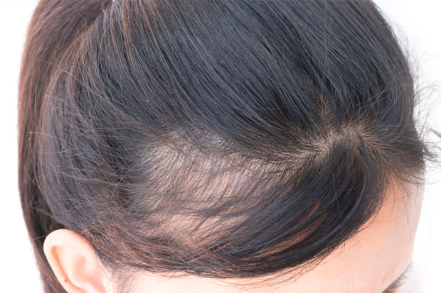 Queda de Cabelo: entenda as principais causas