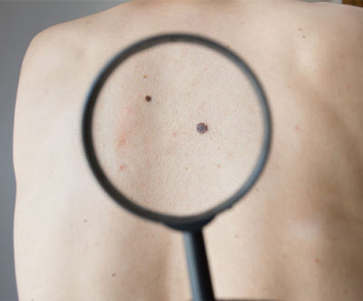 Melanoma: olhe para a sua pele com atenção