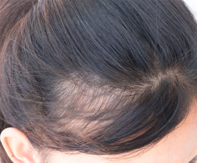 Queda de Cabelo: entenda as principais causas