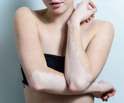Vitiligo: entenda a doença das manchas na pele